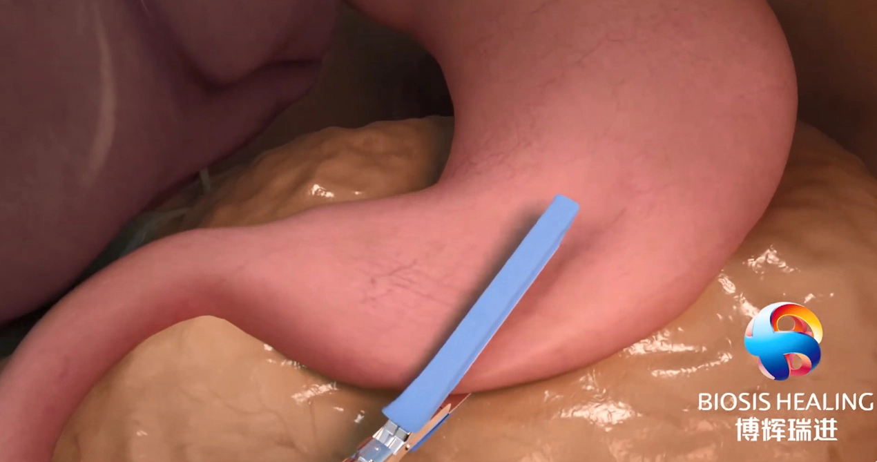 Renforcement des lignes d'agrafes (SLR) pour réduire les fuites