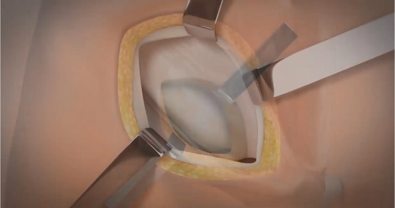 Réparation de hernie lichtenstein avec maille absorbable SIS