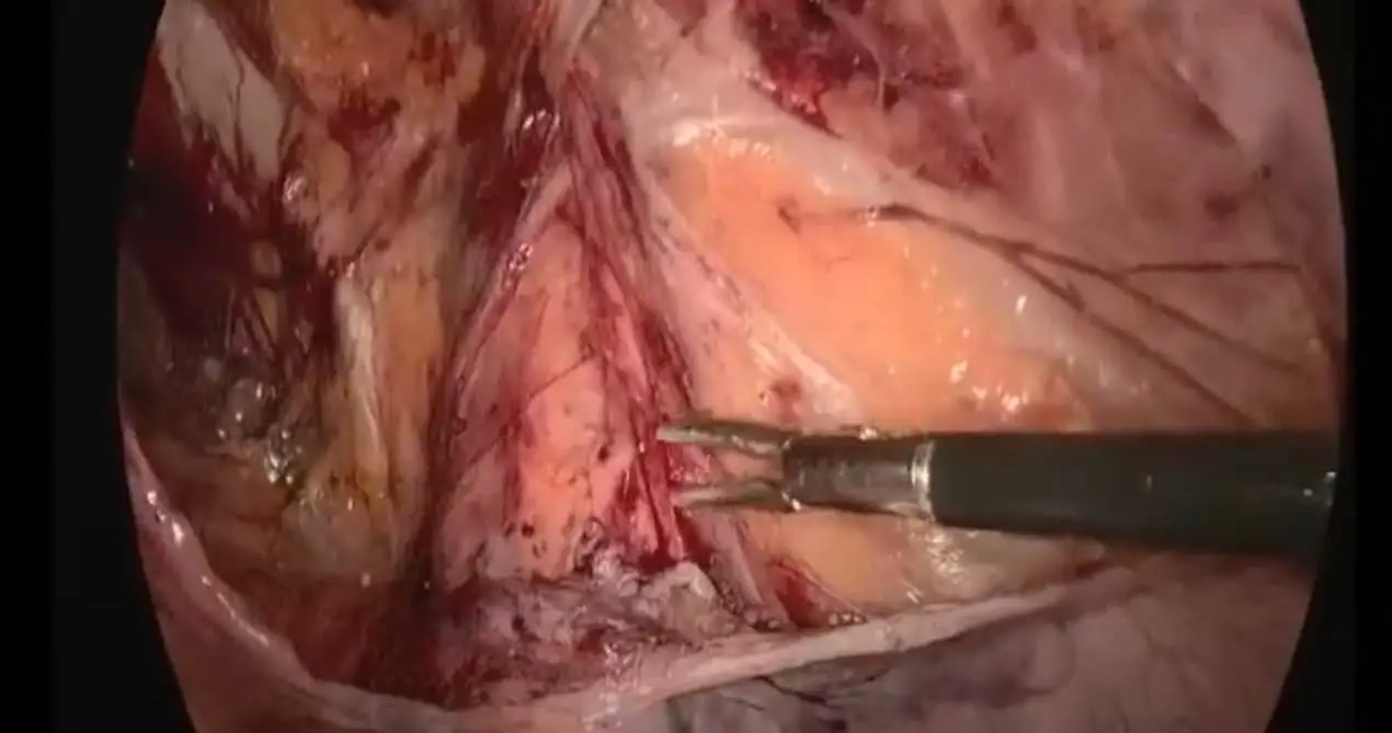 SIS Maille biologique 13x15cm TAPP chirurgie pour réparation de hernie