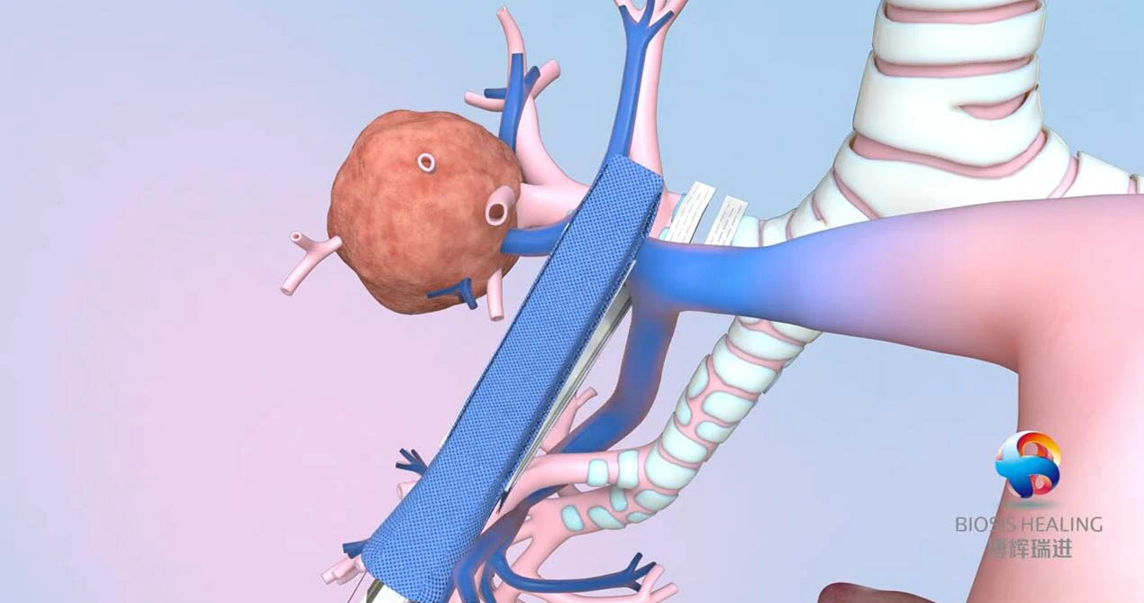 Renforcement de la ligne d'agrafe pour la lobectomie